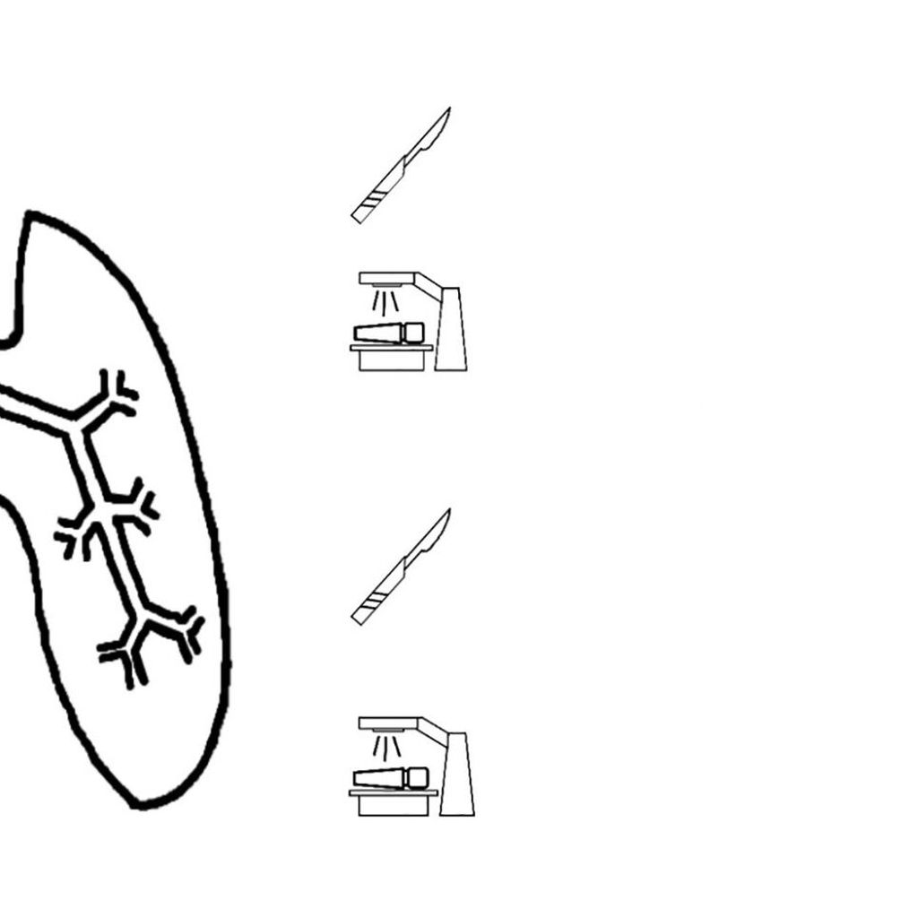 surgery-or-rt-in-nsclc-n2-stage-iii-onkologie-universimed